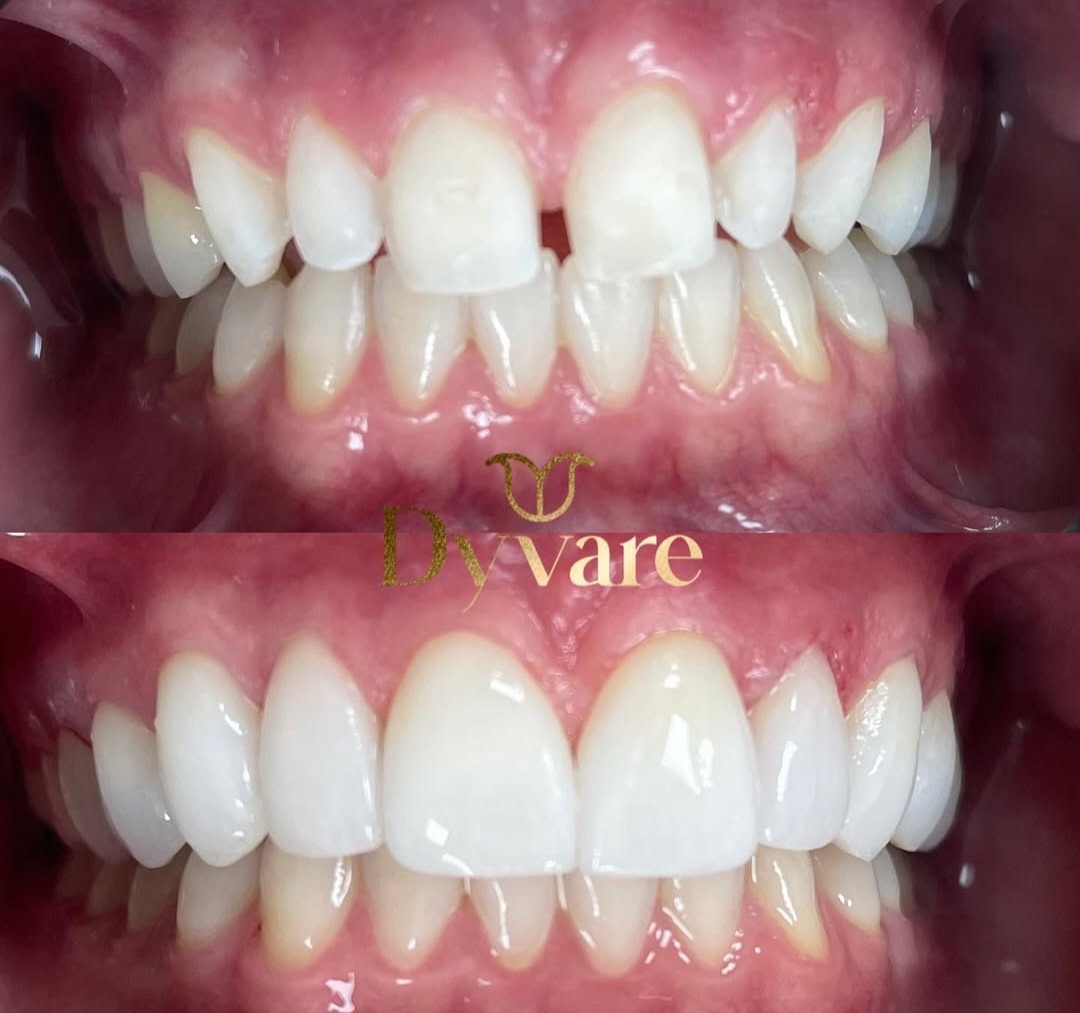 Lentes de Contato Dental - Clínica DYVARE